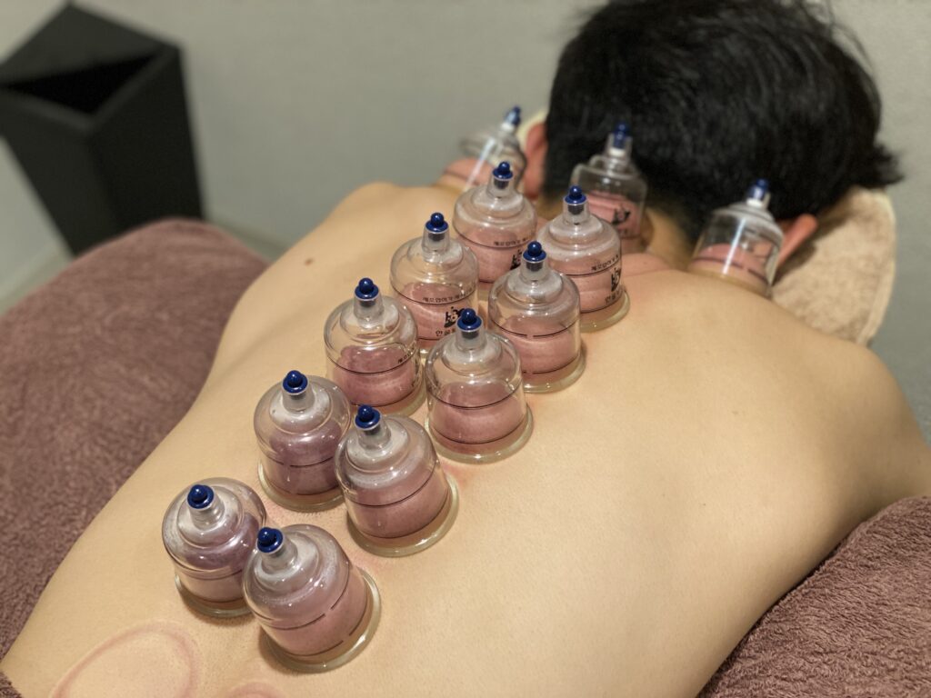 ゴルフ　カッピング治療風景